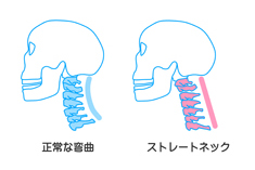 頚性神経筋症候群とは